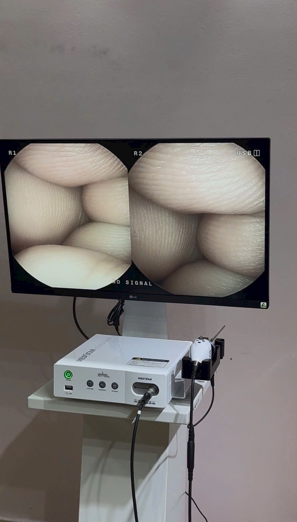 máy nội soi tai mũi họng FCL-100 Medstar Hàn Quốc Full HD - dạng dọc và - hình ảnh thực tế